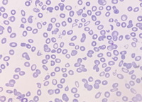 Schistocytes