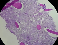 Bone marrow biopsy involving metastatic cells