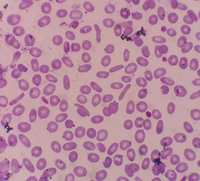 Elliptocytes in PBS 3