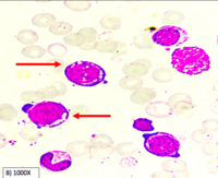 LINEZOLID INDUCED PURE RED CELL APLASIA : PROERYTHROBLAST SHOWING CYTOPLASMIC VACUOLATION