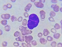 Bare megakaryocyte nuclei (naked nuclei) peripheral blood 1