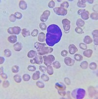 Bare megakaryocyte nucleus in a peripheral blood smear 2