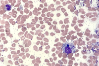 Peripheral blood smear shows a circulating hemphagocytic histiocyte