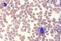 Peripheral Blood Smear Shows A Circulating Hemphagocytic Histiocyte