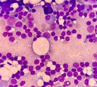 Lymphoplasmacytic lymphoma 1