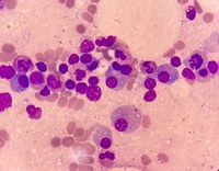 Lymphoplasmacytic lymphoma 2