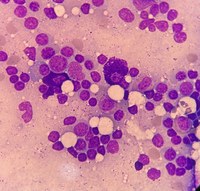 Lymphoplasmacytic lymphoma 3