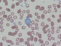 Large and abnormal platelets in the setting of Megakaryoblastic crisis