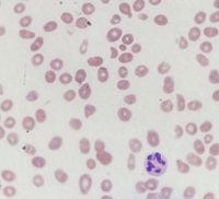 severe-b12-deficiency-with-ttp-like-presentation