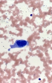 Circulating megakaryocyte in peripheral blood smear