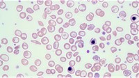 Sickle cell- beta thalassemia
