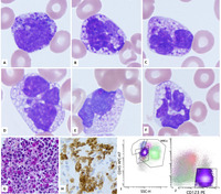 Degranulated basophils in myeloproliferative neoplasm.