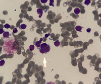 AML-M7 category with micro-megakaryocytes 3