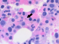 Panel C: Babesia on bone marrow core biopsy