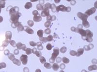 Panel E: severe Babesiosis