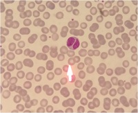 Bilobed lymphocytes 1