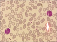 Bilobed lymphocytes 2