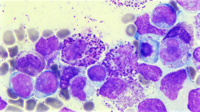 AML with inv(16)