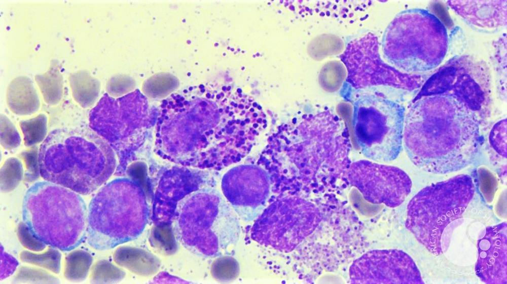 AML with inv(16)