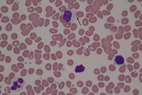 Large Granular Lymphocyte in T-LGL Leukemia