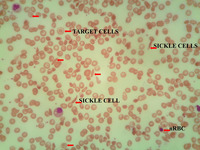 Sickle cell/β+ thalassemia