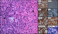 Extranodal Nasal type NK-T cell Lymphoma