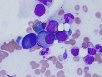 MGG 100x Aspirate
