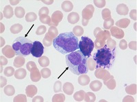 chronic myelogenous leukemia