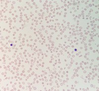 Beta-thalassemia intermedia