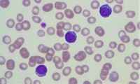 Plasma cell leukemia