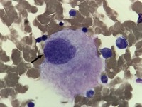 megakaryocyte in bone marrow