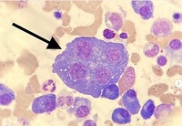 Multinucleated Plasma cell