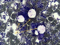 Fat Cells in Bone Marrow