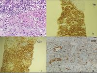 T lymphoblastic leukemia with granulomas