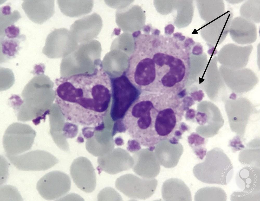 Neutrophil aggregate with Platelet Satellitism