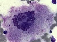 Megakaryocyte with hyperlobulated nuclei