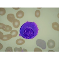 flame-cells-in-plasma-cell-leukemia