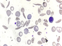 Sickle cell anemia in a hemolytic crisis