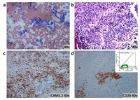 Simultaneous bone marrow involvement by B-cell lymphoma and metastatic small cell carcinoma