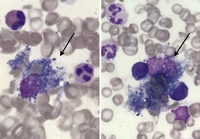 Macrophages containing blue- gray hemosiderin pigment