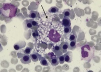 Foamy Macrophage in bone marrow