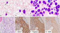 Mast Cell Leukemia