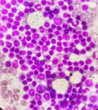 Mature lymphocytes with interspersed prolymphocytes