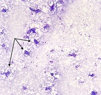 Diffuse Bone Marrow Metastasis of Breast Cancer 1