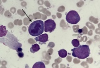 Mitosis in a bone marrow aspirate-2