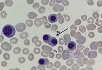 Mitosis in a bone marrow aspirate-4