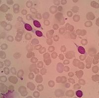 splenic marginal zone lymphoma