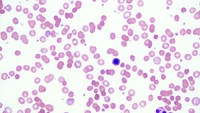 Hereditary spherocytosis