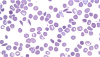 Sickle cell anemia