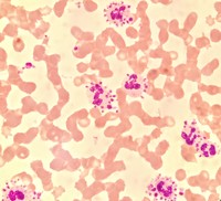 PLATELET SATELLITISM : A RARE PHENOMENON